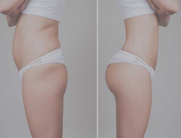 Résultat lipofilling fesses Tunisie