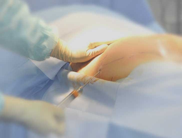 deroulement lipofilling fessier Tunisie