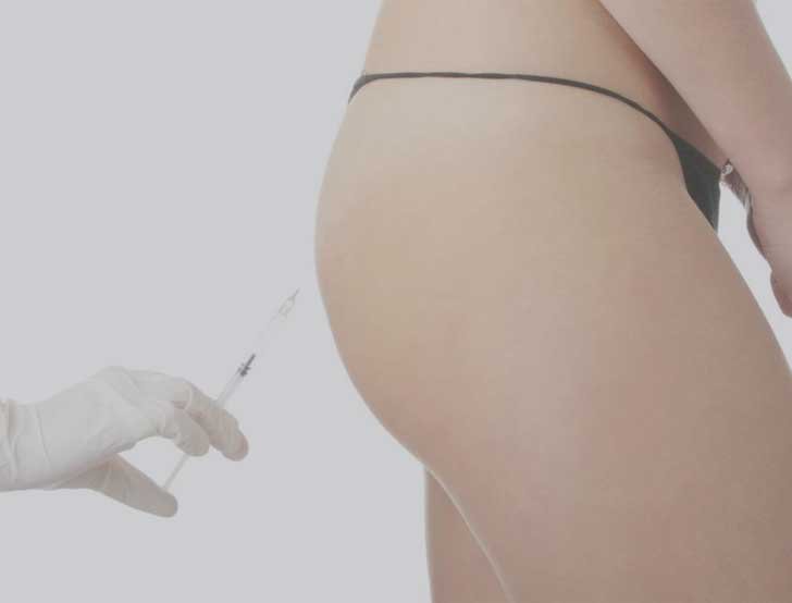 Injection Sculptra fesses avis