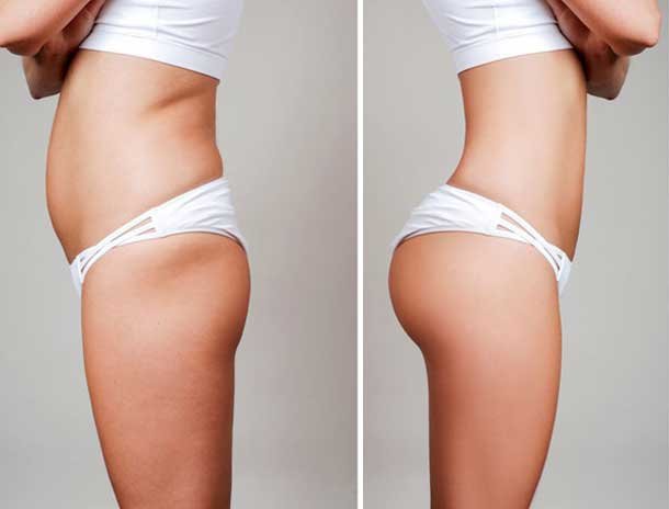 Photos rsultat lipofilling fessier Tunisie